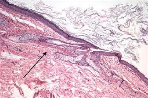 Histology showing cyst hair follicle, sebaceous and sweat glands ...