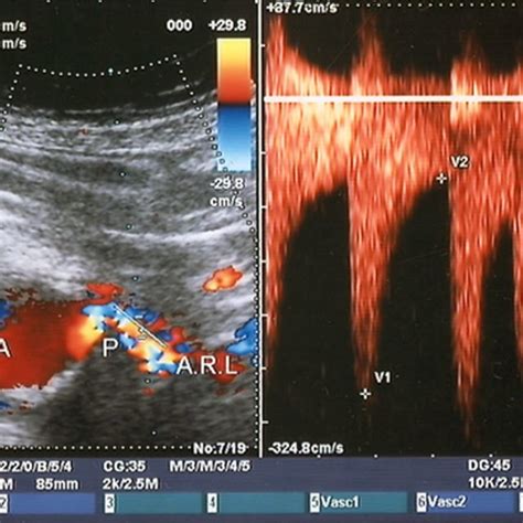 (PDF) Ultrasound diagnostics of renal artery stenosis