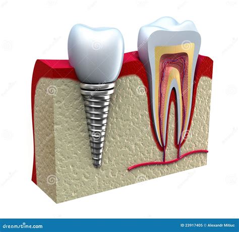 Anatomy of Healthy Teeth and Dental Implant Stock Illustration - Illustration of health, medical ...