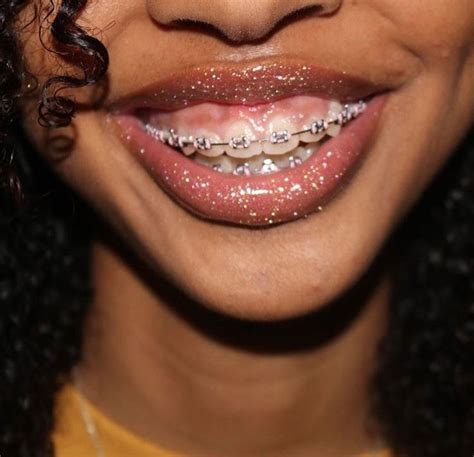 @nbashy🌈🤟🏽 | Cute braces, Braces colors, Teeth braces