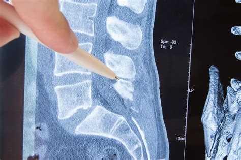 Photo MRI lumbosacral spine pathology. Radiologist indicated on possible pathology or disease of ...