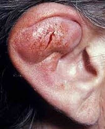 Otitis Externa (Swimmers Ear) Symptoms, Causes, Types (Malignant Otitis Externa) and Treatment