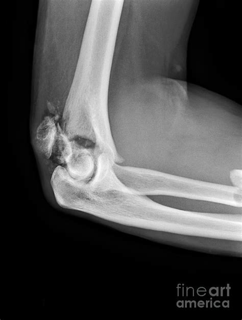 Broken Elbow, X-ray #1 by Science Photo Library