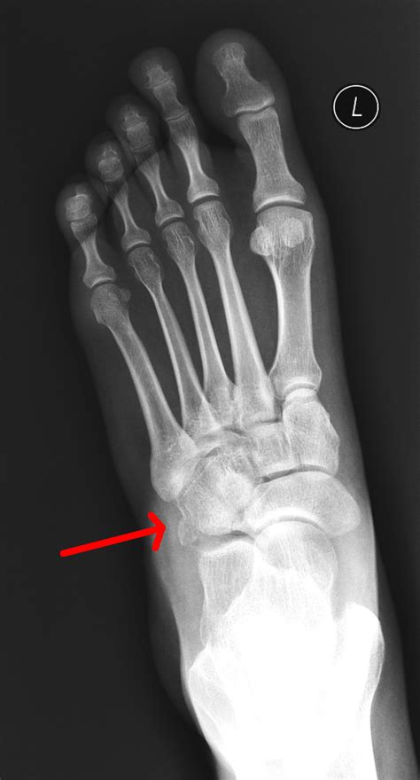 Foot Case 7 Answer: Orthopedic Teaching: Feinberg School of Medicine