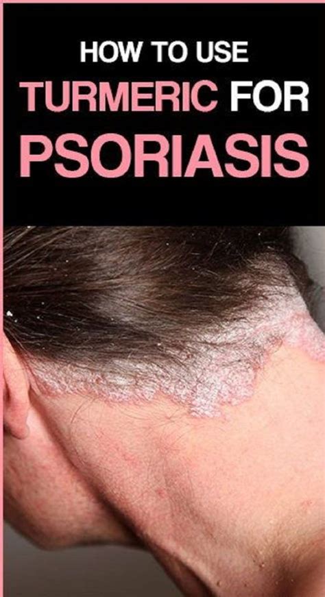 How to Use Turmeric for Psoriasis? | Psoriasis cure, Psoriasis, Natural psoriasis remedies