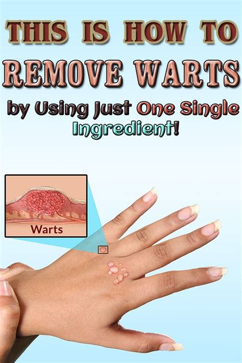 How to Remove Warts by Using Just One Single Ingredient! | Warts, Get ...