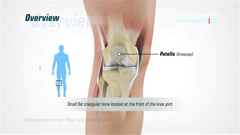 Patellofemoral Pain Syndrome Video | Medical Video Library