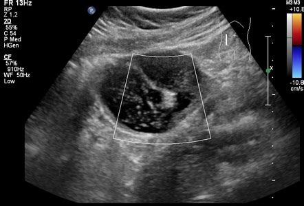 Teratoma Ovary Ultrasound