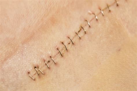 How Do Surgical Wounds Close? | Sanara MedTech