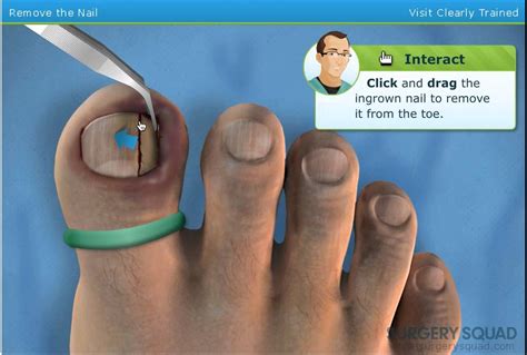 ingrown toenail removal surgery - YouTube