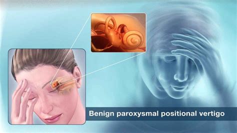 What are the major causes of benign paroxysmal positional vertigo ...