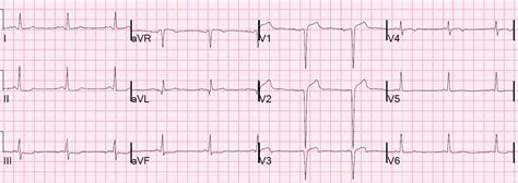 Dr. Smith's ECG Blog: Reciprocal ST depression in II, III, aVF. What is ...