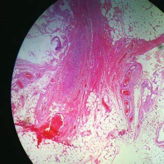 Microscopic view of greater omentum showing Acute on chronic... | Download Scientific Diagram