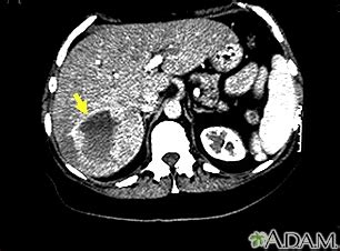 Hepatic hemangioma Information | Mount Sinai - New York