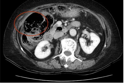 Colon Perforation and Abscess. Axial CT 3. Annotated. JETem 2019 - JETem