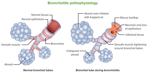 BCV for Respiratory Syncytial Virus (RSV) - Hayek Medical