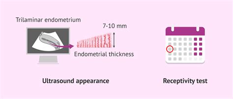 Ultrasound assessment of the endometrium and the window of implantation.