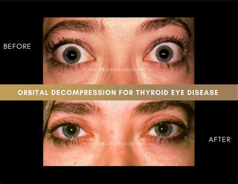 Thyroid Eye Disease Photos - Plastic Eye Surgery Associates