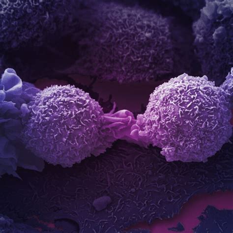 Cancer overdiagnosis linked to 'irrational exuberance' for screening | STAT