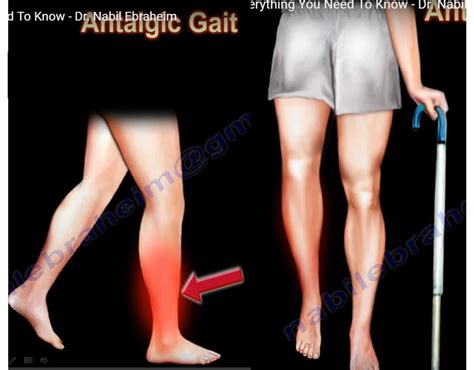 Antalgic gait — OrthopaedicPrinciples.com