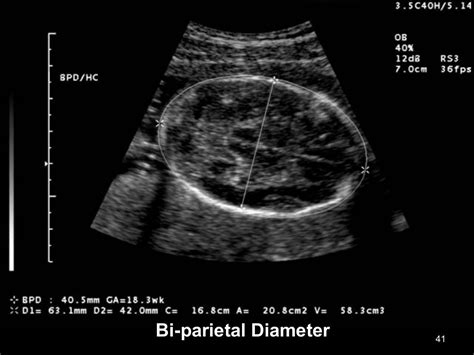 Obstetric ultrasound