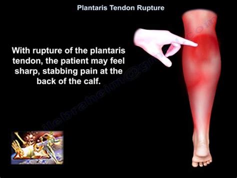 Plantaris Tendon Rupture - Everything You Need To Know - Dr. Nabil Ebraheim - YouTube