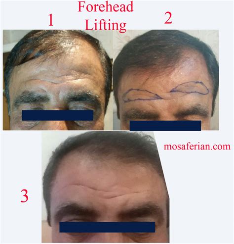 brow lift scars - Niayesh Beauty Clinic Brow lift scars