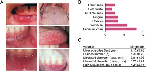 Clinical manifestations of recurrent aphthous stomatitis. (A ...