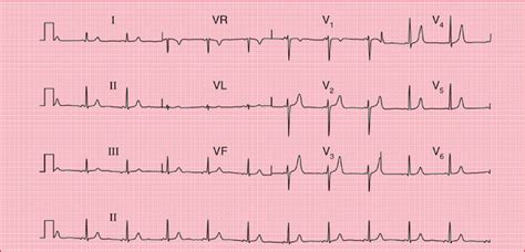 The ECG in Patients with Palpitations or Syncope | Thoracic Key