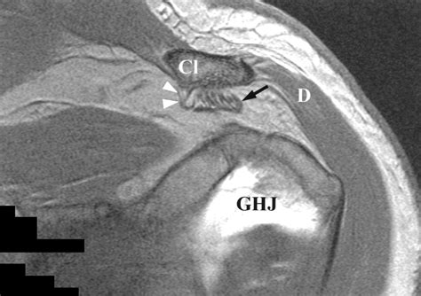 Coracoacromial Ligament Mri