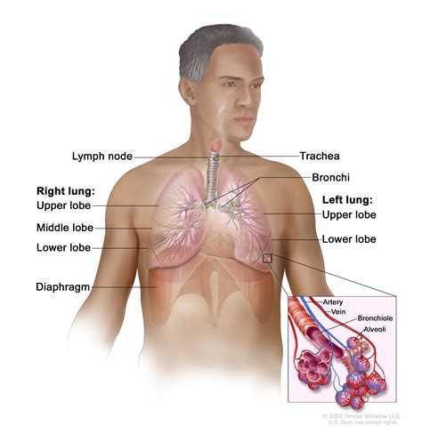 Lung Cancer Screening - NCI