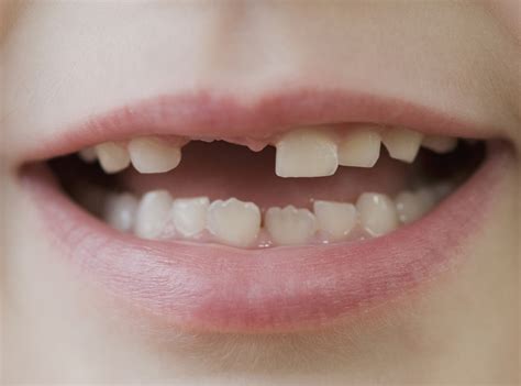 Does Doxycycline Cause Tooth Discoloration in Younger Patients? - MPR