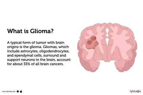 Glioma: Treatment, Procedure, Cost, Recovery, Side Effects And More