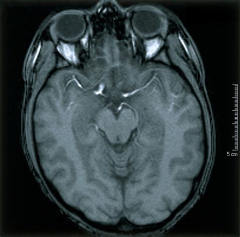 Normal brain. 2 Axial MRI scan | Wellcome Collection