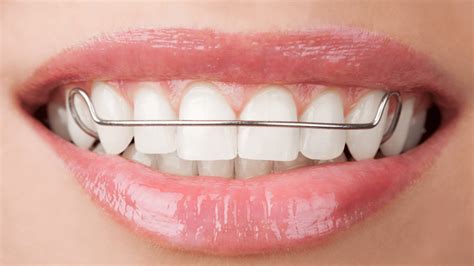 Is a Retainer Needed After Invisalign®Treatment?