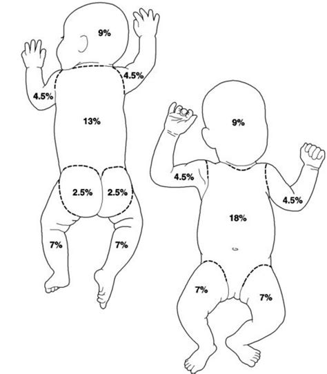 Burn Classification for Infants - Lund and Browder. Burns Nursing, Nursing Exam, Nursing School ...