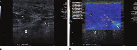 Acute tennis leg injury in a 51-year-old man. (a) Long-axis gray-scale... | Download Scientific ...