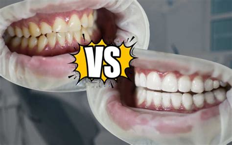 Veneers vs Lumineers: Which One To Get The Smile of Your Dreams?