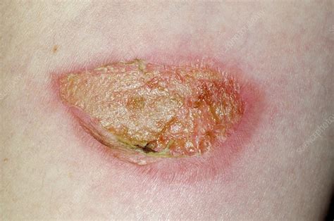 Infected burn on the arm - Stock Image - C016/7242 - Science Photo Library