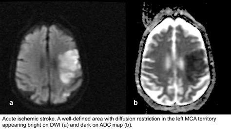 Update on Management of Acute Ischemic Stroke in The Emergency Department | RECAPEM