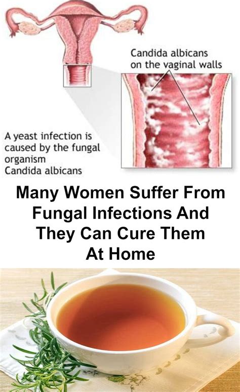 Many Women Suffer From Fungal Infections And They Can Cure Them At Home ...