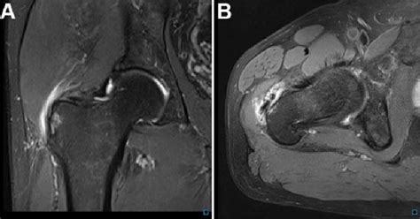 Mri Scans Of A Patient With Gluteal Tendinopathy And An Mhip Score Of 8 ...