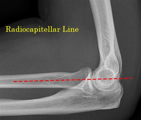 Radiocapitellar line | Radiology Case | Radiopaedia.org | Medical anatomy, Radiology, Human ...