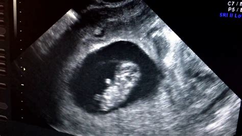 First trimester ultrasound video baby is waving at us. - YouTube