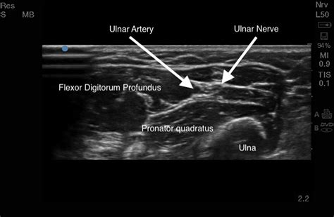 Median Nerve Ultrasound