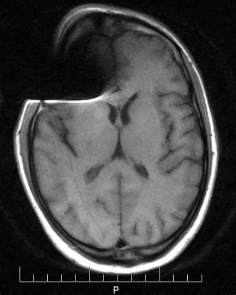 magnetic susceptibility artifact | pacs