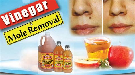 Apple Cider Vinegar Mole Removal | is apple cider vinegar treatment for ...