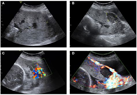 Placenta Accreta Vs Normal Placenta