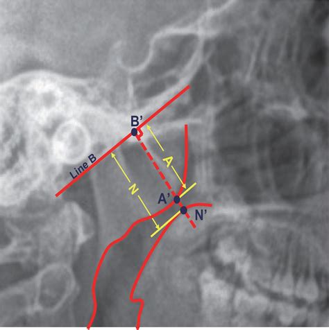 Adenoid Hypertrophy X Ray