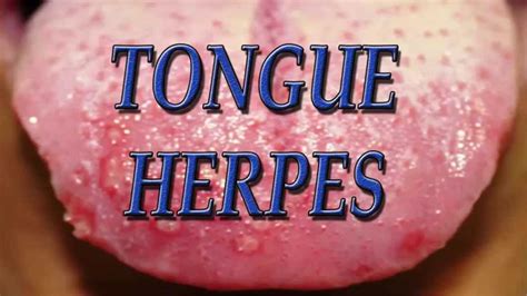 Herpes On Tongue: Causes, Symptoms And Guaranteed Natural Treatment - Mouthwash Guide For Oral ...